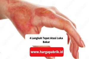 4 Langkah Tepat Atasi Luka Bakar