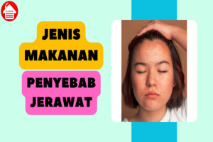 5 Jenis Makanan Penyebab Jerawat yang Perlu Dihindari